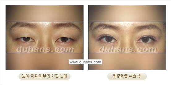 [두한성형외과 경쟁력 눈성형]- [최소 부기로 일상의로의 복귀가 가능한 아름다운 퀵쌍꺼풀(부분절개법) 수술] 관련 이미지 13