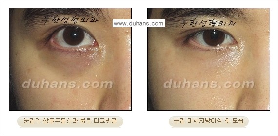 [두한성형외과 경쟁력 미세지방이식] - [다크써클 & 눈밑주름 미세지방이식 5.] 관련 이미지 9