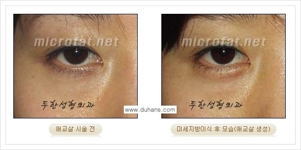 [두한성형외과 경쟁력 눈밑성형] - [눈밑 애교살 미세지방이식 안내] 관련 이미지 8