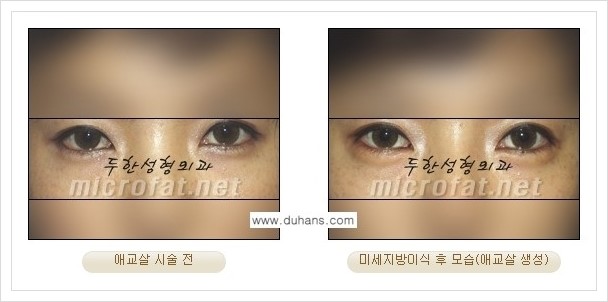 [두한성형외과 경쟁력 눈밑성형] - [눈밑 다크써클과 눈밑 애교살과의 관계] 관련 이미지 8