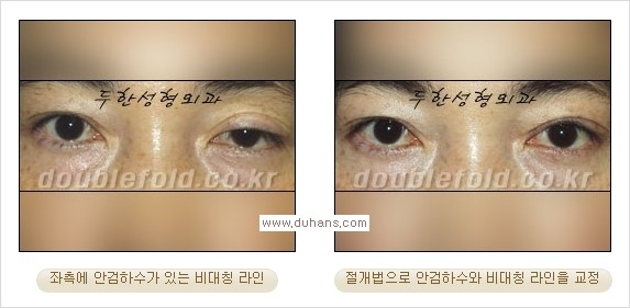 [두한성형외과 경쟁력 쌍꺼풀 재수술, 극한 눈재수술] - [안검하수 검사 및 수술방법 안내] 관련 이미지 19