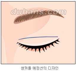 쌍커풀수술 두한성형외과 - 나에게 맞는 눈성형은? 관련 이미지 17