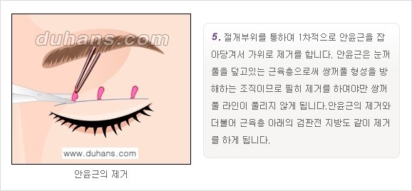 [두한성형외과 경쟁력 눈성형]- [최소 부기로 일상의로의 복귀가 가능한 아름다운 퀵쌍꺼풀(부분절개법) 수술] 관련 이미지 5