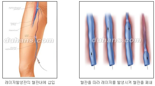 [두한성형외과 정맥류] - [하지정맥류, 정맥확장증, 혈관확장증] 관련 이미지 18