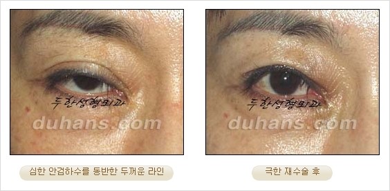 [두한성형외과 경쟁력 쌍꺼풀 재수술 리더 ] - [쌍꺼풀 재수술 과정, 쌍꺼풀 재수술 실패의 원인, 극한 재수술] 관련 이미지 5