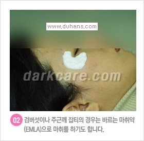 [두한성형외과 경쟁력 눈밑성형] - [다크써클 + 검버섯 레이저 콤비 프로그램 안내] 관련 이미지 4