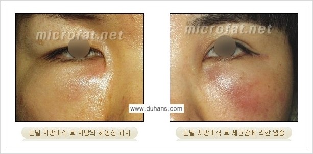 [두한성형외과 경쟁력 지방이식] - [미세지방이식, 자가지방이식, 지방주입의 잘못된 정보 안내] 관련 이미지 3