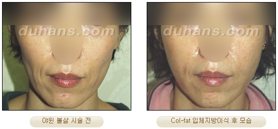 [Duhan Plastic Surgery Facial Autologous Fat Grafting] - [Fat Grafting Guide] image 34