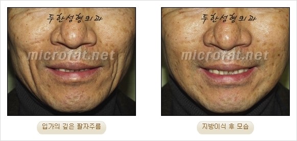 [두한성형외과 경쟁력 안티에이징 동안성형] - [주름이 깊은 푹~ 꺼진 입가 팔자주름 안녕!] 관련 이미지 23