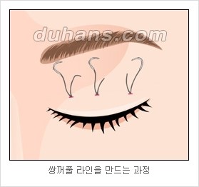 [두한성형외과 경쟁력 눈성형 리더] - [아름다운 눈매를 위한 쌍꺼풀 수술 안내] 관련 이미지 10