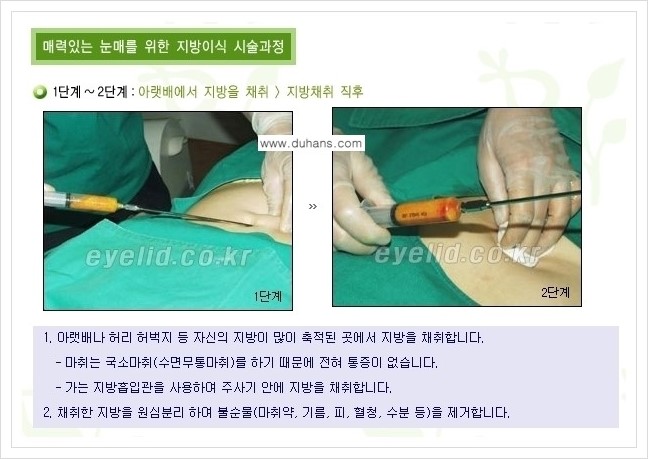 [두한성형외과 경쟁력 눈밑성형] - [다크써클 수술 안내 1.] 관련 이미지 6
