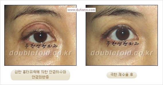 [두한성형외과 경쟁력 쌍꺼풀 재수술] - [피부 여유분이 부족해서 토안증이 발생한 경우 극한 재수술] 관련 이미지 10