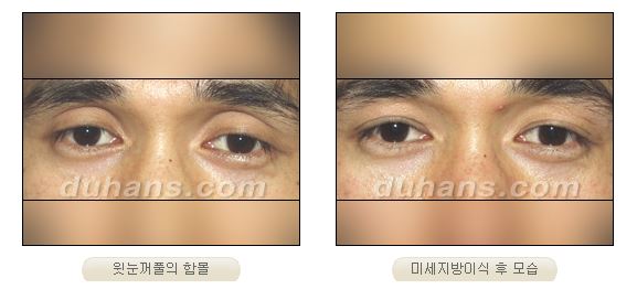 ✨눈 위 꺼짐, 단순 미용이 아닌 기능까지 고려해야 하는 이유✨ 관련 이미지 2