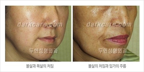 [두한성형외과 경쟁력 주름성형] - [주름제거를 위한 리프팅] 관련 이미지 12