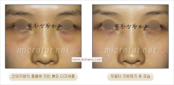 [두한성형외과 경쟁력 눈밑성형] - [과도한 눈밑지방제거의 부작용 후 눈밑지방재배치] 관련 이미지 19