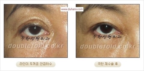 ​[두한성형외과 눈재수술] - [앞트임복원, 뒤트임복원, 쌍꺼풀복원] 관련 이미지 26
