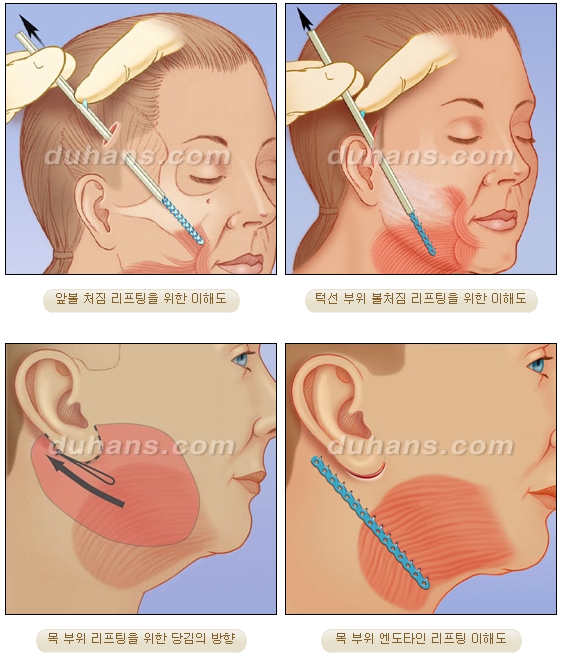 [Duhan Plastic Surgery Wrinkle Removal] - [Wrinkle Removal Treatment Methods] image 39