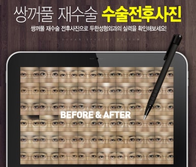 [두한성형외과 쌍커풀재수술] - [개인의 눈매와 특성에 맞는 쌍커풀재수술] 관련 이미지 44