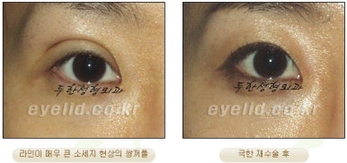 Duhan Plastic Surgery Ophthalmic Reoperation - What Is a Successful Double Eyelid Revision Surgery? image 25