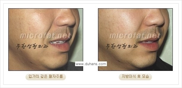 [두한성형외과 경쟁력 미세지방이식] - [입가주름, 팔자주름 교정 안내] 관련 이미지 11