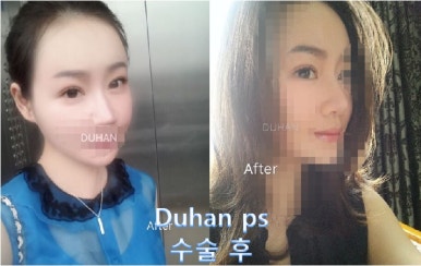 [두한성형외과 쌍커풀재수술] - [심한 소세지눈, 두줄따기, 쌍꺼풀 흉터] 관련 이미지 47