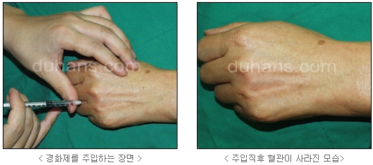 [두한성형외과 정맥류] - [하지정맥류, 정맥확장증, 혈관확장증] 관련 이미지 52