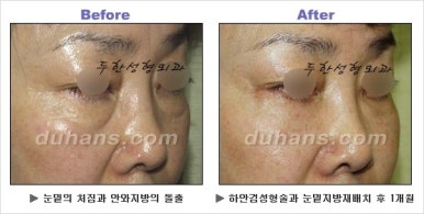 [두한성형외과 안검성형] - [상안검, 하안검] 관련 이미지 43