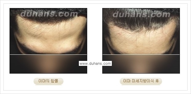 [두한성형외과 경쟁력 얼굴미세지방이식] - [볼살지방이식, 이마지방이식, 측두부지방이식 안내] 관련 이미지 3