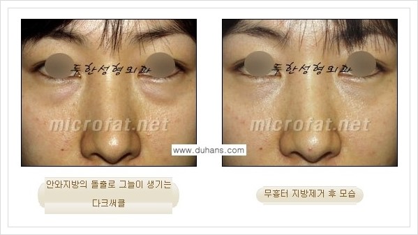 [두한성형외과 경쟁력 눈밑성형] - [눈밑지방제거, 눈위지방제거 안내 1.] 관련 이미지 13