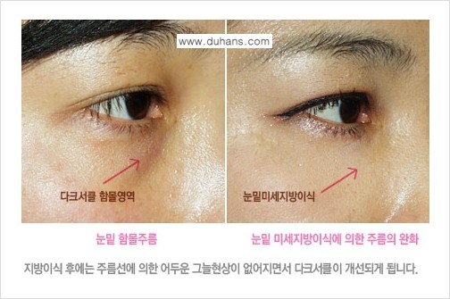 [두한성형외과 FOCUS 눈밑성형] - [다크써클의 치료방법 -  콜펫(Col-fat) 눈밑 미세지방이식 ⑤] 관련 이미지 5