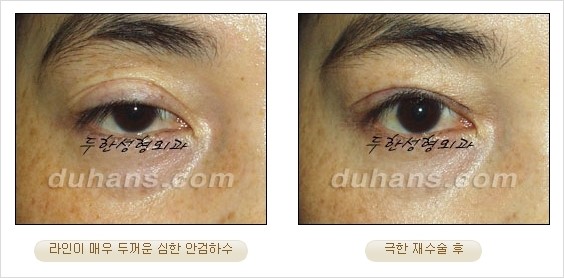 [두한성형외과 경쟁력 쌍꺼풀 재수술 리더 ] - [쌍꺼풀 재수술 과정, 쌍꺼풀 재수술 실패의 원인, 극한 재수술] 관련 이미지 13