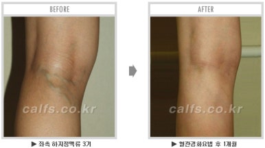 ​[두한성형외과 종아리수술] - [나에게 맞는 종아리성형방법] 관련 이미지 46