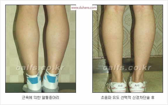 [두한성형외과 경쟁력 종아리성형 리더] - [종아리 성형 안내] 관련 이미지 8