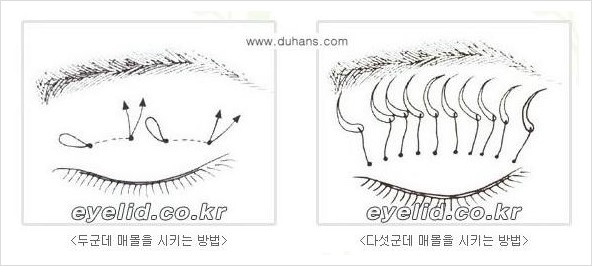 [두한성형외과 경쟁력 맞춤 눈성형] - [매몰법, 절개법의 수술 방법] 관련 이미지 2