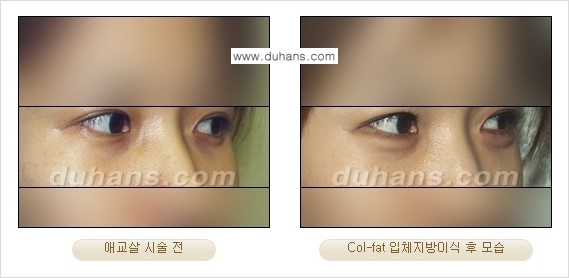 [두한성형외과 경쟁력 미세지방이식]-[Col-fat 입체지방이식 사례 안내] 관련 이미지 6
