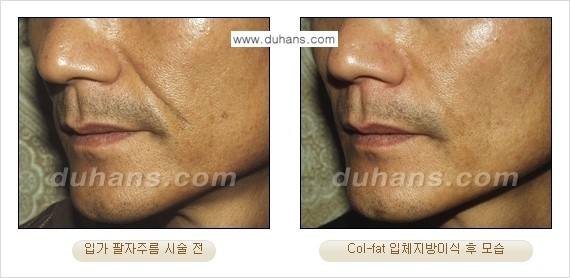 [두한성형외과 경쟁력 미세지방이식]-[Col-fat 입체지방이식 사례 안내] 관련 이미지 8