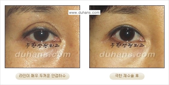 [두한성형외과 경쟁력 눈성형] - [두꺼운 라인을 교정하는 극한 눈 재수술 2.] 관련 이미지 10