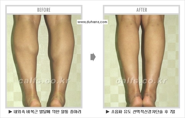 [두한성형외과 경쟁력 멀티종아리성형] - [종아리성형 전후 주의해야 할 내용 안내] 관련 이미지 12
