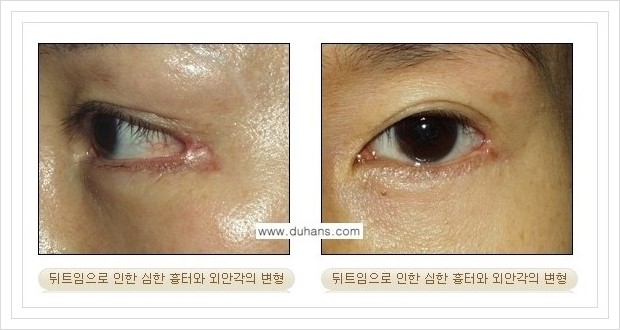 [두한성형외과 경쟁력 쌍꺼풀 재수술, 극한 재수술] - [뒤트임 수술에 대한 안내] 관련 이미지 9
