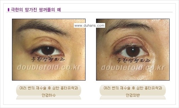 [두한성형외과 경쟁력 쌍꺼풀 재수술, 극한 재수술] - [망친 눈 복원 극한 재수술] 관련 이미지 1