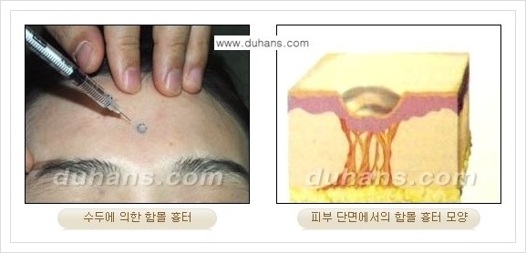 [두한성형외과 경쟁력 함몰 흉터 교정] - [동시에 3가지 시술로 효과적인 함몰 흉터 교정 안내] 관련 이미지 1