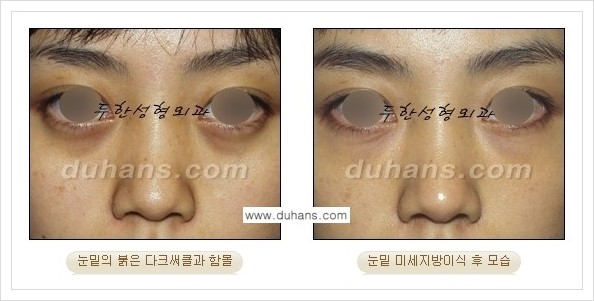 [두한성형외과 경쟁력 눈밑성형] - [꺼진 눈밑, 눈밑 함몰 주름선 눈밑 미세지방이식 안내] 관련 이미지 22