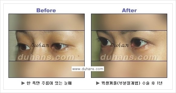 [두한성형외과 경쟁력 쌍꺼풀 재수술, 극한 재수술] - [퀵쌍꺼풀 안내] 관련 이미지 12