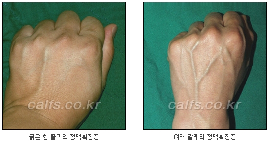 두한성형외과 보기싫은 혈관제거 - 눈밑혈관, 손과 팔의 혈관확장증 치료 관련 이미지 23