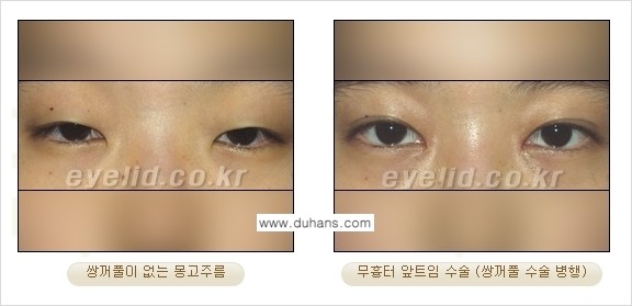 [두한성형외과 경쟁력 눈성형] - [몽고주름 제거수술, 앞트임 수술 안내] 관련 이미지 15