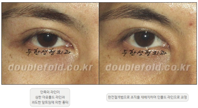 [Double Eyelid Surgery Duhan Plastic Surgery] - [Revision Methods] image 9
