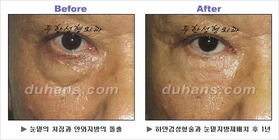 [두한성형외과 경쟁력 동안성형 리더] - ​[미간주름, 이마주름, 안검성형, 이마거상술, 눈썹거상술] 관련 이미지 70
