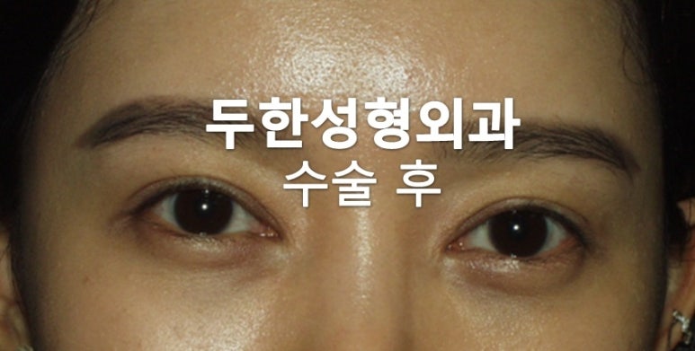 [Duhan Plastic Surgery Double Eyelid Revision Surgery] - [Lowering the Double Eyelid Line, Reducing the Double Eyelid Line, Sausage Eye Revision Surgery, Under-Eye Fat Grafting, Aegyo-sal] image 2