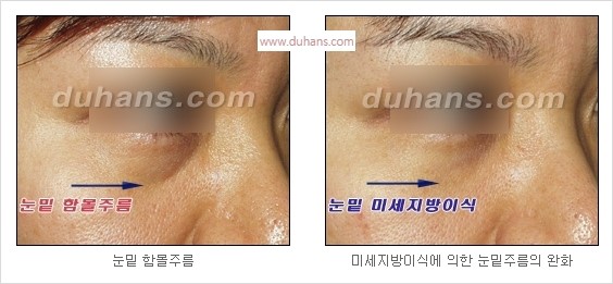 [두한성형외과 경쟁력 안검성형] - [젊은 눈매 안검성형의 여러 가지 방법 안내] 관련 이미지 70