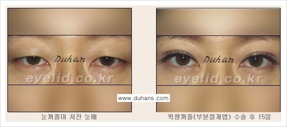 [언론속의 두한성형외과] - [▶ 티 나지 않는 쌍꺼풀수술이 진짜다? ◀] 관련 이미지 2